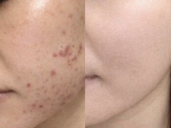 beauty salon LALA 大阪南森町｜ハーブピーリング・肌質改善・インディバの写真/21時迄【赤み,ブツブツ,肌荒れ跡】栄養爆弾パックsetで白玉艶肌◎ハーブピーリングで秋のゆらぎ肌をケア♪