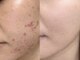 beauty salon LALA 大阪南森町｜ハーブピーリング・肌質改善・インディバの写真/21時迄【赤み,ブツブツ,肌荒れ跡】栄養爆弾パックsetで白玉艶肌◎ハーブピーリングで秋のゆらぎ肌をケア♪