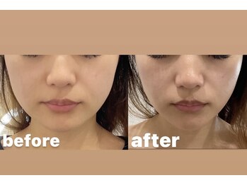 ヴェヌスタ サカイ(VENUSTA SAKAI)/BBLフェイシャルbeforeafter