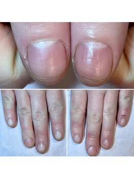 ココデネイル(cocode nail)/悩み:爪の形(20代前半)