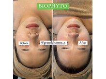 グランドシャルムエス(Grand Charme S)/南森町/ニキビ/毛穴/