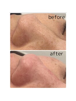 ムー(mu)/毛穴美人コース×光フェイシャル