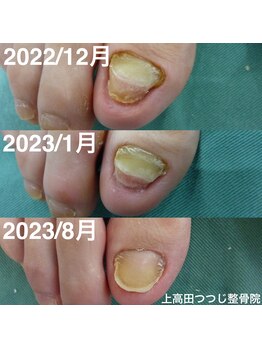 上高田つつじ整体院/肥厚爪 ネイルケア 例