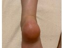 13)踵,足裏ツルプル角質育成ケア