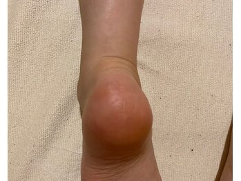 ビサンテ サロン/13)踵,足裏ツルプル角質育成ケア