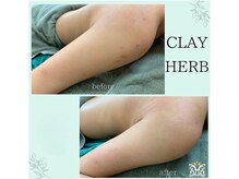 ダイヤモンド リーエンダ(Diamond leende)/クレイハーブピーリングBODY