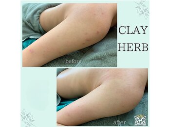 ダイヤモンド リーエンダ(Diamond leende)/クレイハーブピーリングBODY