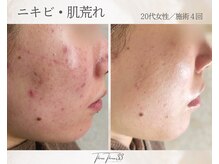 スリースリー(THREE THREE)/ニキビ・肌荒れケア