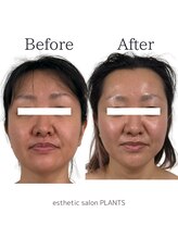 プランツ(PLANTS)/40代／4回／たるみ小顔・くすみ