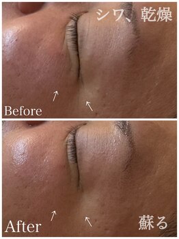 リノ(lino)/角質ケアパックでシワ、毛穴レス