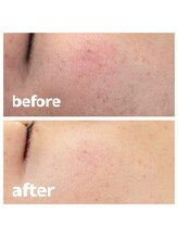 マーズ(mars)/ハーブピーリング