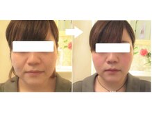 サロンドエステケイワイ(de KY)/フェイシャル☆小顔・タルミ改善