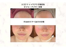 サロン ド マハロ(Salon de MAHALO)/話題の韓国ピーリングLHALALA