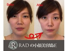 ラッド(RAD)