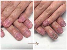 キュアネイル(Qa Nail)/ハンド【深爪矯正】初日変化！
