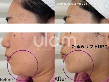 ミラ 中央林間(mira)/小顔　毛穴　ホワイトニング