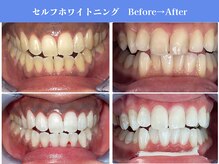 エクシアホワイトニング 岡崎店/岡崎エリア★口コミ・来店数No.1