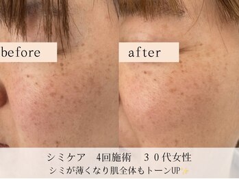 モラン(MO.RAN)/シミケア4回でトーンアップ