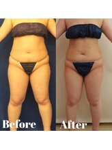 トータルビューティサロン クイーン(Queen)/ガチガチ太ももはボディスタンプ