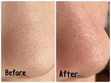 ソイズエステティクス/【毛穴ケア＋炭酸バブルパック】