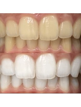 ホワイトニングセンター 大阪京橋店/BeforeAfter