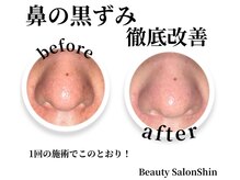 シン(Shin)/【小鼻ケア】