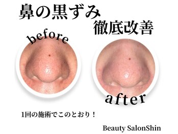 シン(Shin)/【小鼻ケア】