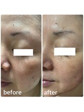 アズ(AZU)/●before after