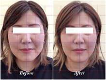 べっぷ餅ヶ浜鍼灸院/美容鍼Before/ After