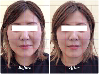 べっぷ餅ヶ浜鍼灸院/美容鍼Before/ After