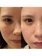 ルミナ シブヤ(LUMINA SHIBUYA)/シミケア5回目