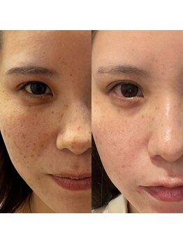 ルミナ シブヤ(LUMINA SHIBUYA)/シミケア5回目