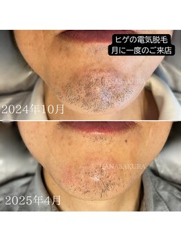 ハナサクラ 心斎橋(HANASAKURA)/ヒゲの白髪には電気脱毛がベスト