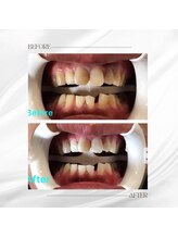 ホワイトニングセンター 大阪羽曳野店/歯科提携ホワイトニング症例