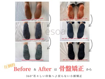 エソア(esoa)/小顔矯正