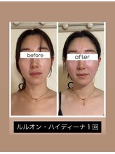 ヨサパーク リアン(YOSA PARK Lien)/ルルオン(ハーブ蒸し)