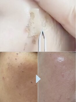 リリア(Lilia)/１回でポロっと最新シミケア