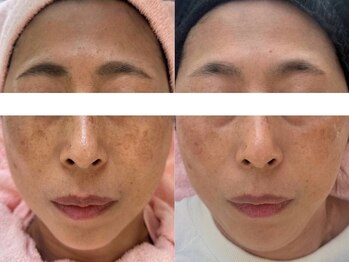 シミケア専門店 SAKURA 平塚店/年齢なんて関係ない