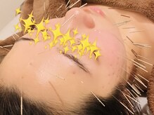 オリエンタル ルボワール(oriental Revoir)/顔鍼50本　美容鍼灸