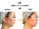 アルピナ(ALPINA)の写真/ほうれい線・たるみ改善!筋膜リフトで若見え小顔へ