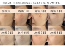 モラン(MO.RAN)/「本気のシミケア」でシミ改善