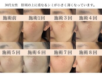 モラン(MO.RAN)/「本気のシミケア」でシミ改善
