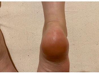 ビサンテ サロン/14)踵,足裏ツルプル角質育成ケア