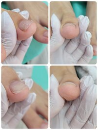 巻き爪　陥入爪