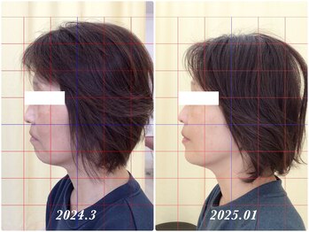 べっぷ餅ヶ浜鍼灸院/美容鍼Before/ After