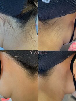ワイスタディオ(Y studio)/春前オススメ　うなじ脱毛