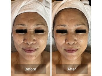 ミンク(Mink)/エイジング★1回の施術