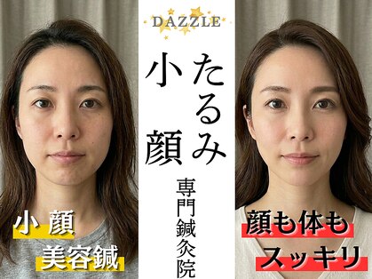 ダズル(DAZZLE)の写真