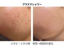 エルヴェ(Eleve)/ニキビの原因菌にアプローチ