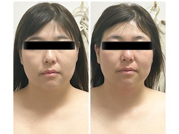 ラン(Ran)/レモンボトルでスッキリ小顔